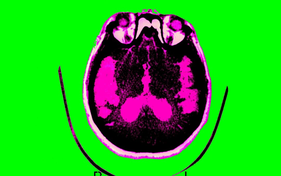 Scientists are finally starting to figure out Alzheimer’s